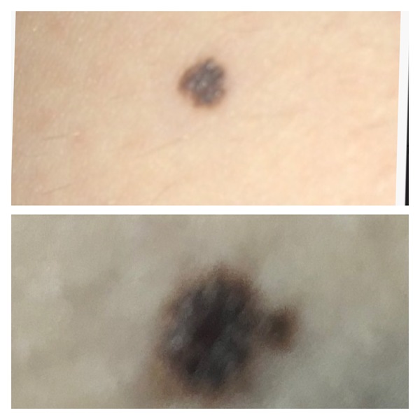 Pretty sure I have a melanoma (skin cancer)