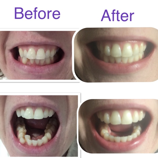 To ask if anyone has done Invisalign or other adult braces?