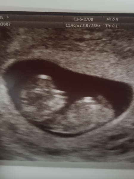 August 2019 Part 3: nausea, scans and big reveals