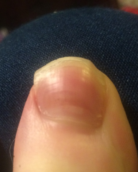 To worry I might have nail cancer?