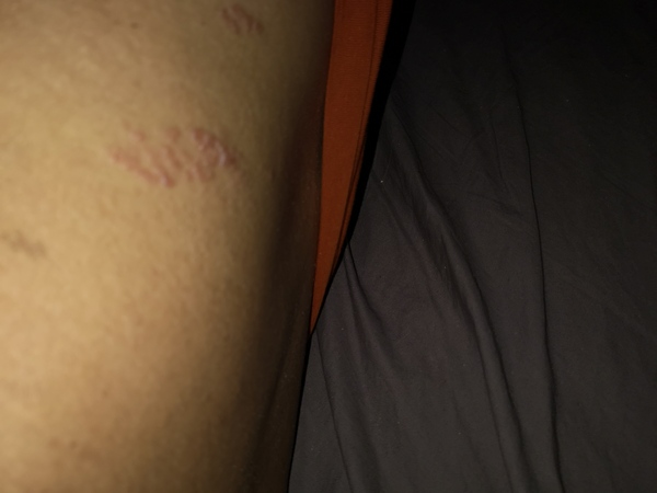 Or is this shingles?