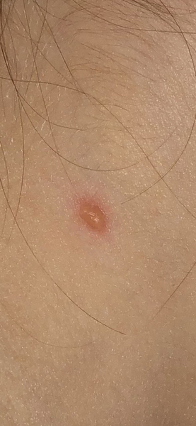 Chicken pox - but only one spot?!