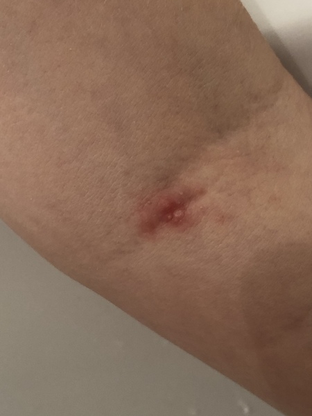 Any idea what this could be (odd rash)