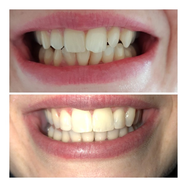 To ask if anyone has done Invisalign or other adult braces?