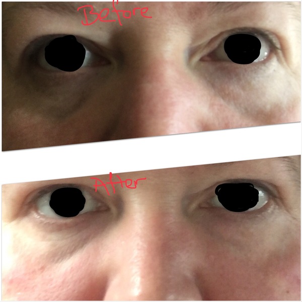 Black circles/hollows - anyone got a magic remedy?