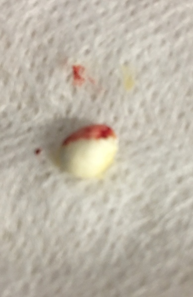 What’s this in child’s ear? (Photo)