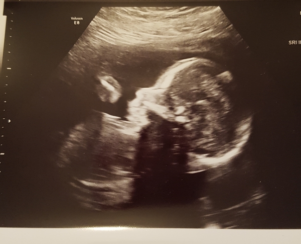 Pregnancy after loss: spring 2019 edition (The Brexit Babes) 🐧 Part 2