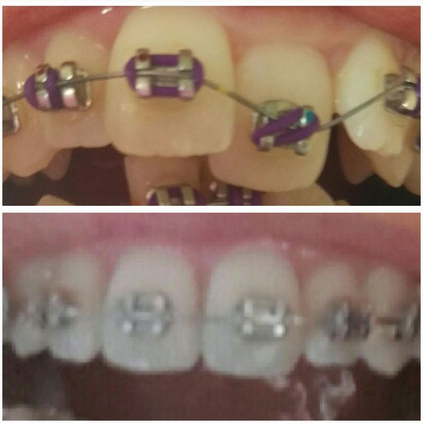 To ask if anyone has done Invisalign or other adult braces?