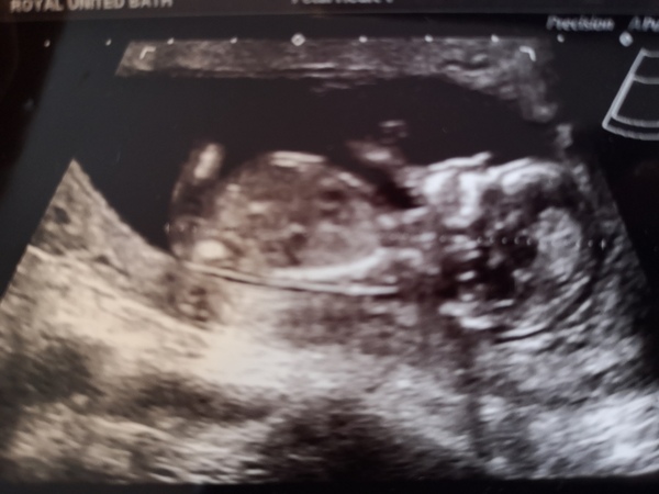 Guess baby's sex!