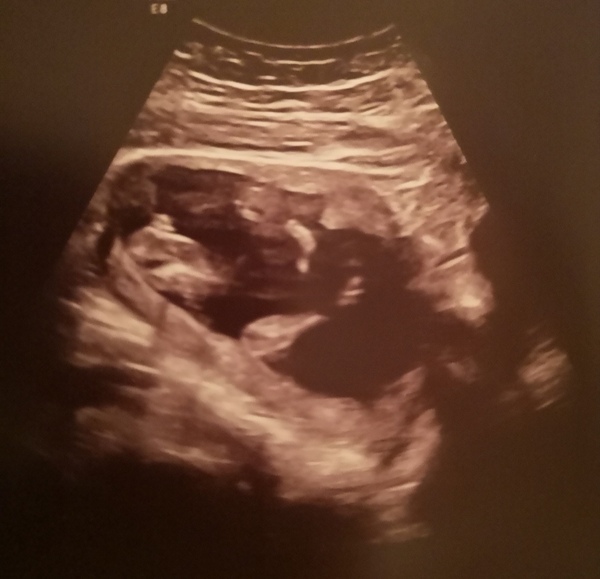 Potty shot help, confirmed both boy and girl!!