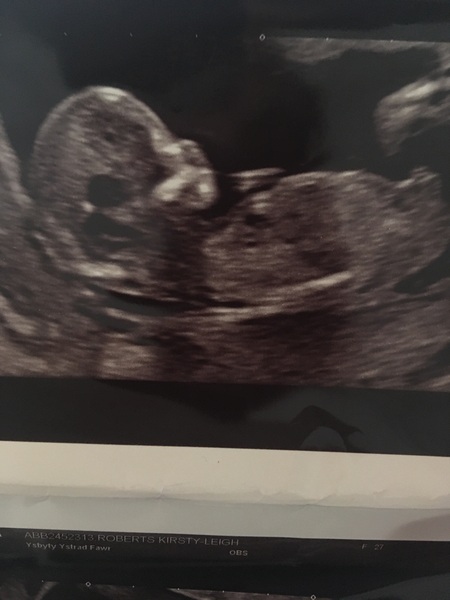 12 week scan nub theory guesses anyone?