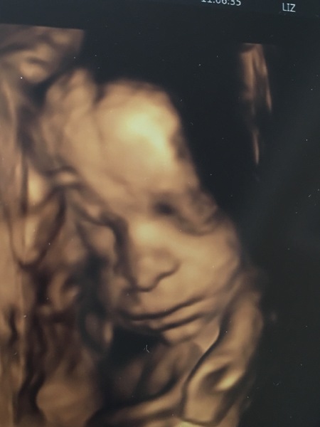 3D scan, no top of head!