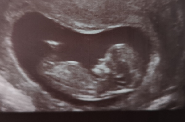 August 2019 4: All the scans and hopefully the end of nausea