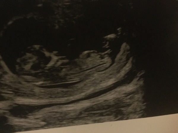 August 2019 Part 3: nausea, scans and big reveals