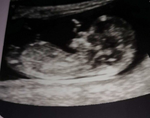 Nearing 20 week scan, boy or girl do you think?