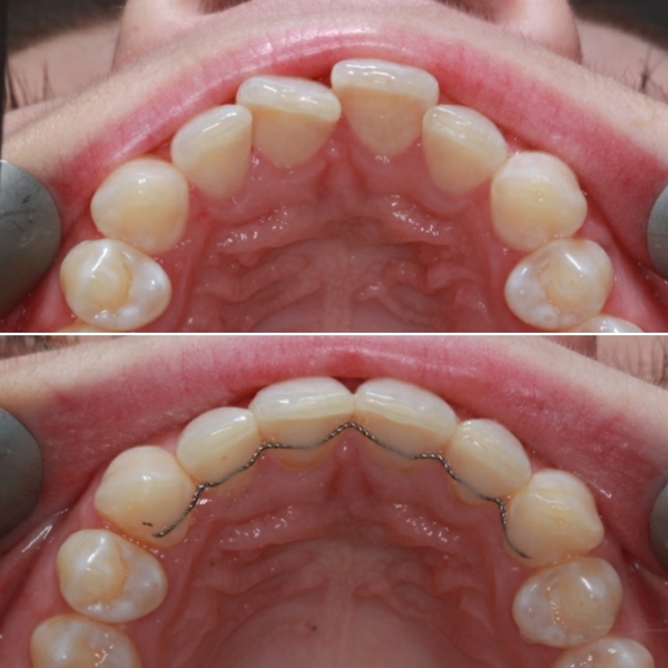 To ask if anyone has done Invisalign or other adult braces?