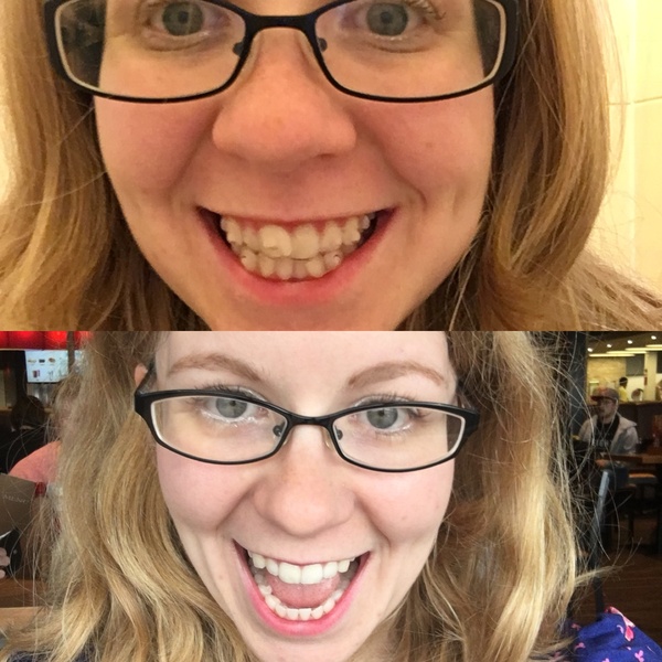 To ask if anyone has done Invisalign or other adult braces?