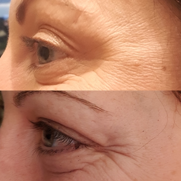 Botox diary