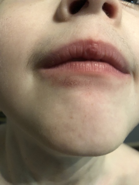 What can I do to help ds’ sore lip? (With pic)