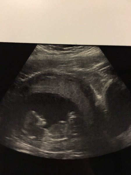 Haven’t been able to have screening, now worried to death about absense of nasal bone on 13 week scan.