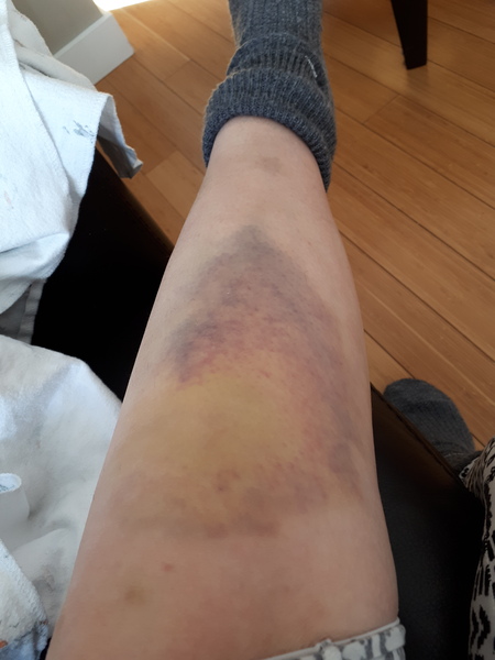How long after a fall would you see a dr?