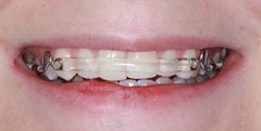 To ask if anyone has done Invisalign or other adult braces?