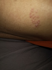 Or is this shingles?