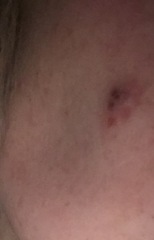 Scared I may have skin cancer