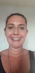 To ask if anyone has done Invisalign or other adult braces?