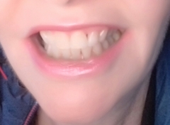 To ask if you have had braces as an adult