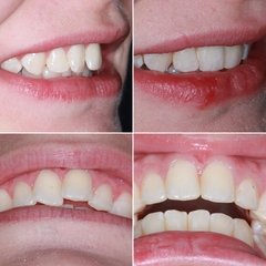 To ask if anyone has done Invisalign or other adult braces?