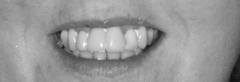 To ask if anyone has done Invisalign or other adult braces?