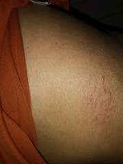 Or is this shingles?