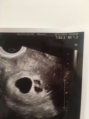 Small sac , correct size baby