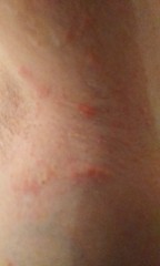 To ask if anyone can tell me if this is scabies? *pic of rash*