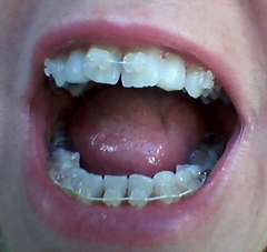 To ask if you have had braces as an adult