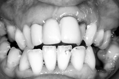 To ask if anyone has done Invisalign or other adult braces?