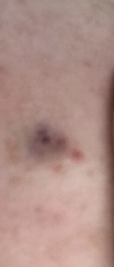 Scared I may have skin cancer