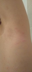 To ask if anyone can tell me if this is scabies? *pic of rash*