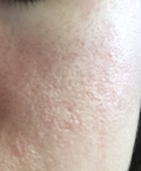 Can I do anything over the counter for my skin? Large pores and acne scars etc (pic attached)