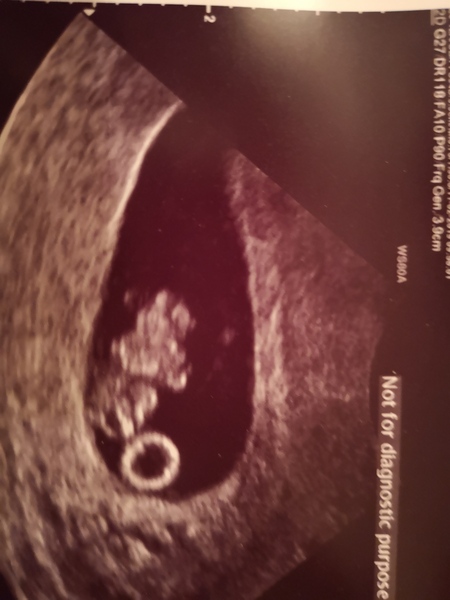 Early scan picture