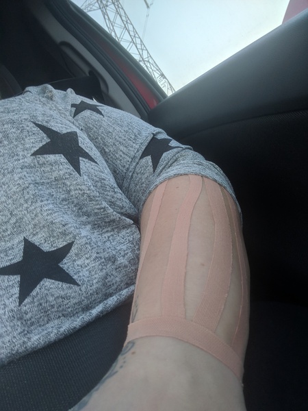 Carpol tunnel 5 day's post op