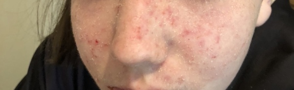 Help please! Cannot get skin condition under control (pics)