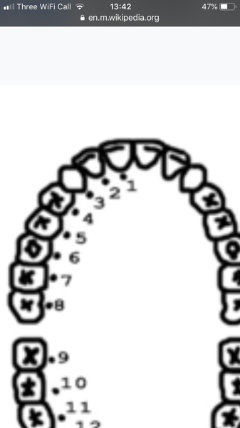 Tooth extraction and fixed brace