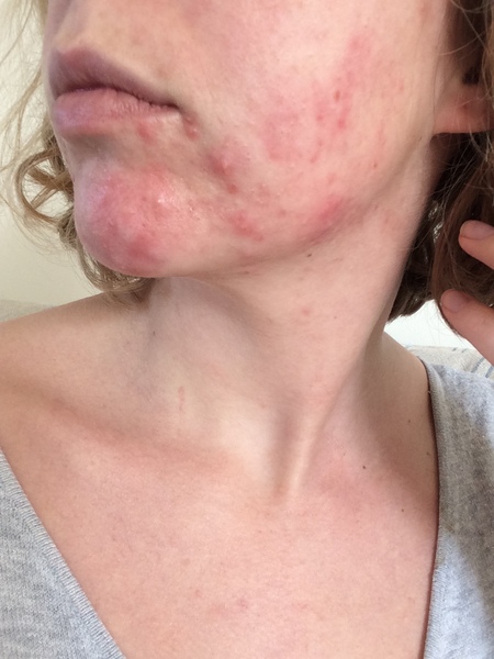 I can’t cope with this awful skin anymore (pic)
