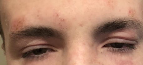Help please! Cannot get skin condition under control (pics)