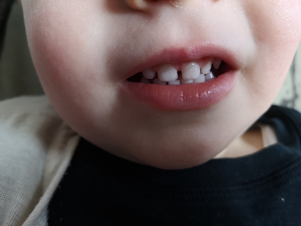 Toddler tooth discolouration