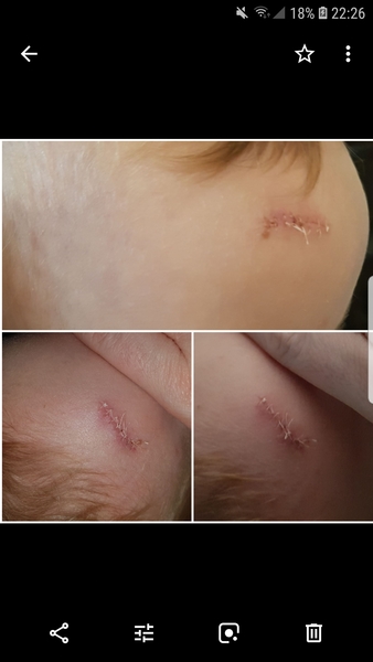 Post appendix nightmare - anyone got any advice