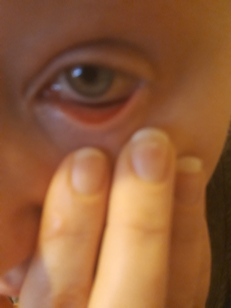 Severe sinus pain around eye