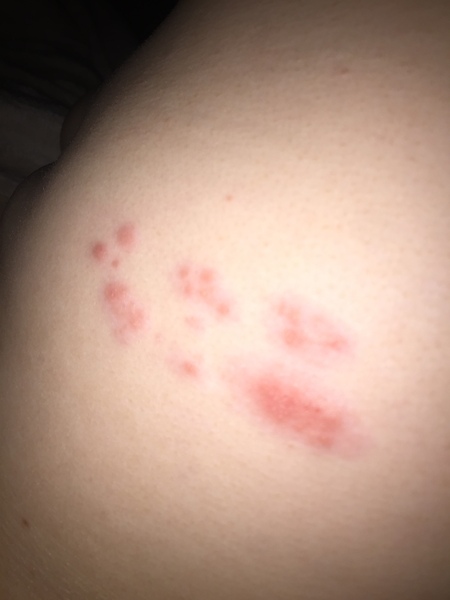 What’s this rash/spots/bites